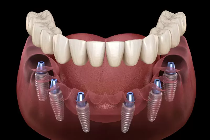 Komple İmplant Tedavisi Nedir?