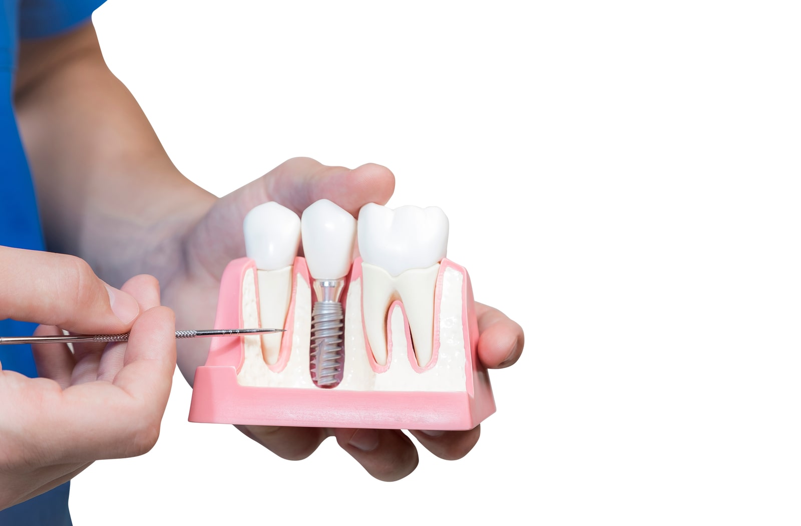 Dental İmplant Yaptırmadan Önce Bilinmesi Gerekenler