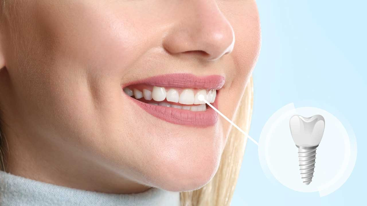İmplantların Estetik Avantajları Nelerdir?
