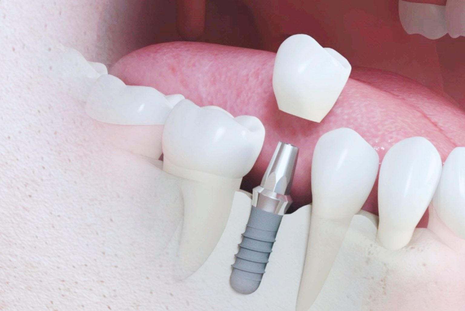 Straumann İmplant Nedir?