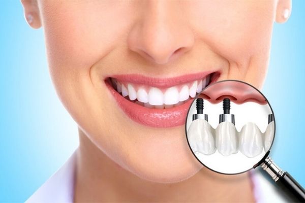 Diş Kayıplarına Çözüm İmplantlarda Saklı