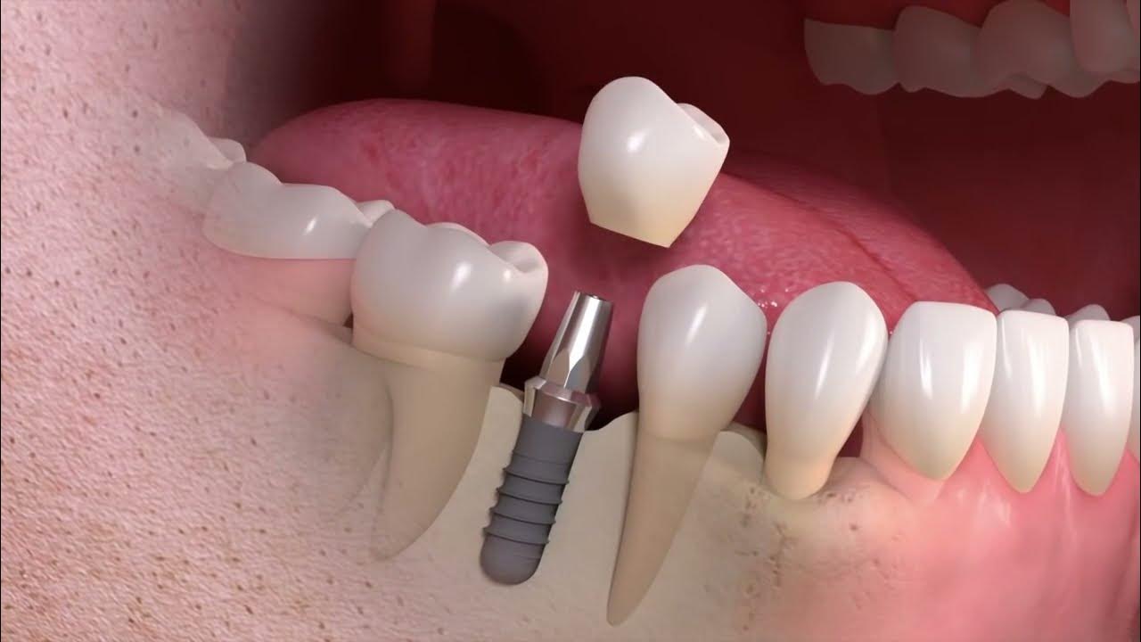 Peri İmplantitis Nedir?