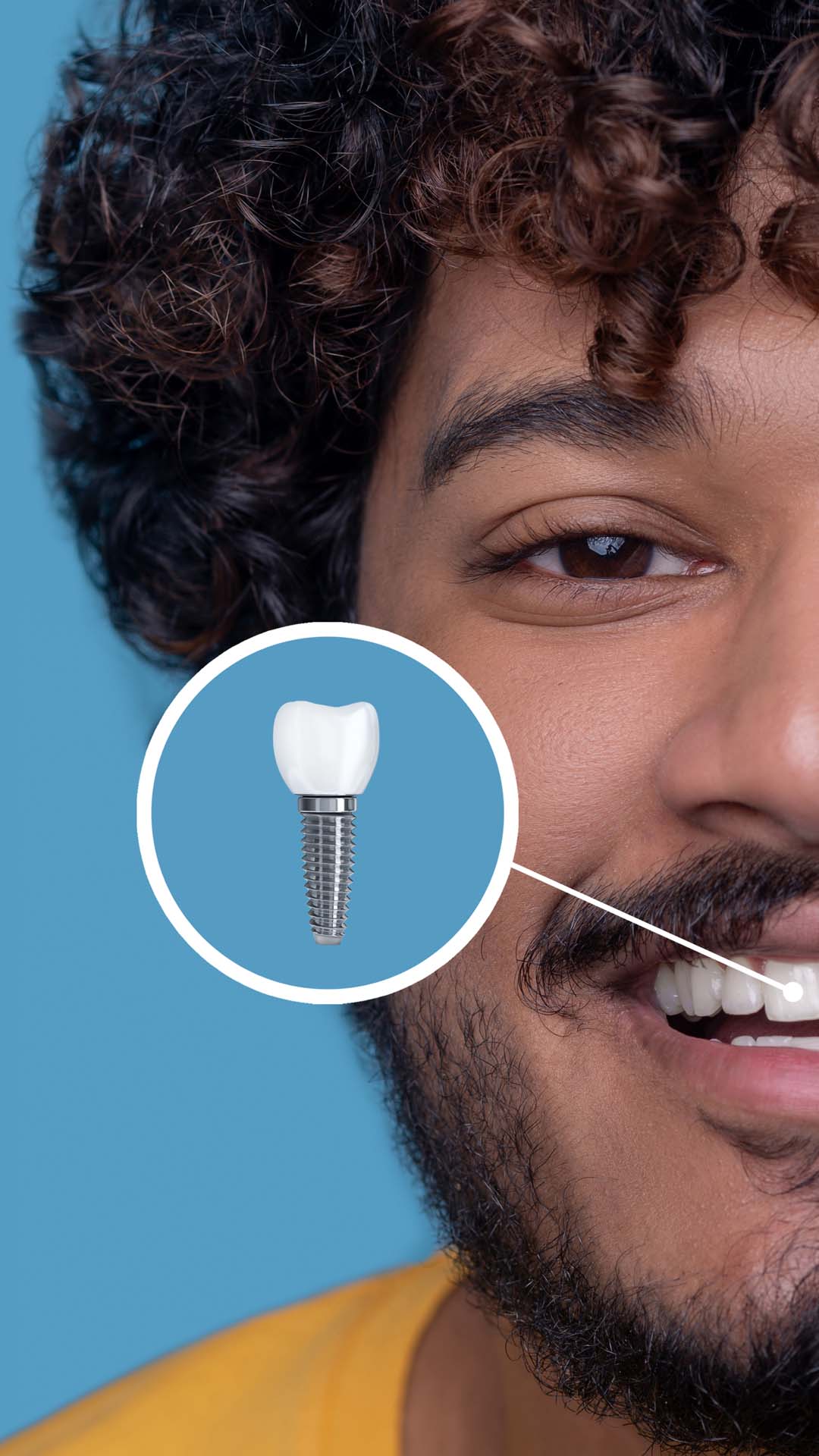 Implant Tedavisi Nedir?